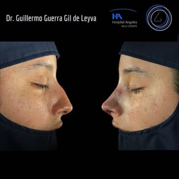 Slider image (10) Dr. Guillermo Guerra Gil de Leyva - Rhinoplasty Specialist